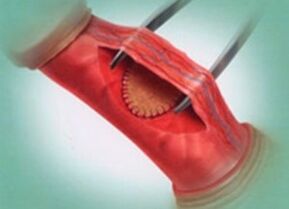 Surgical way to increase a member